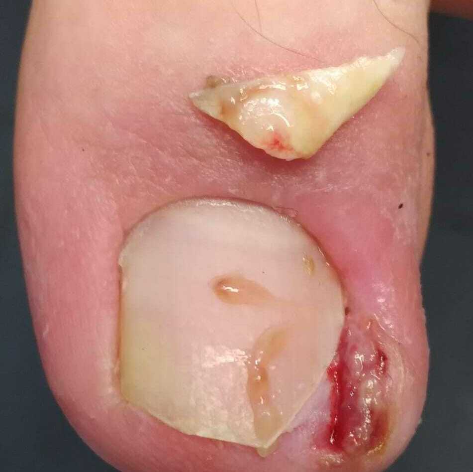 Коррекция вросшей части ногтя