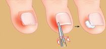 снять боль ногтя с помощью тампонирования