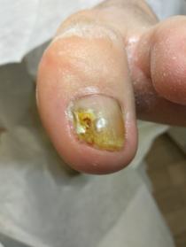 Поражение ногтевой пластины грибковым заболеванием Онихомикоз