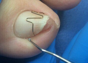Коррекция ногтевой пластины нить