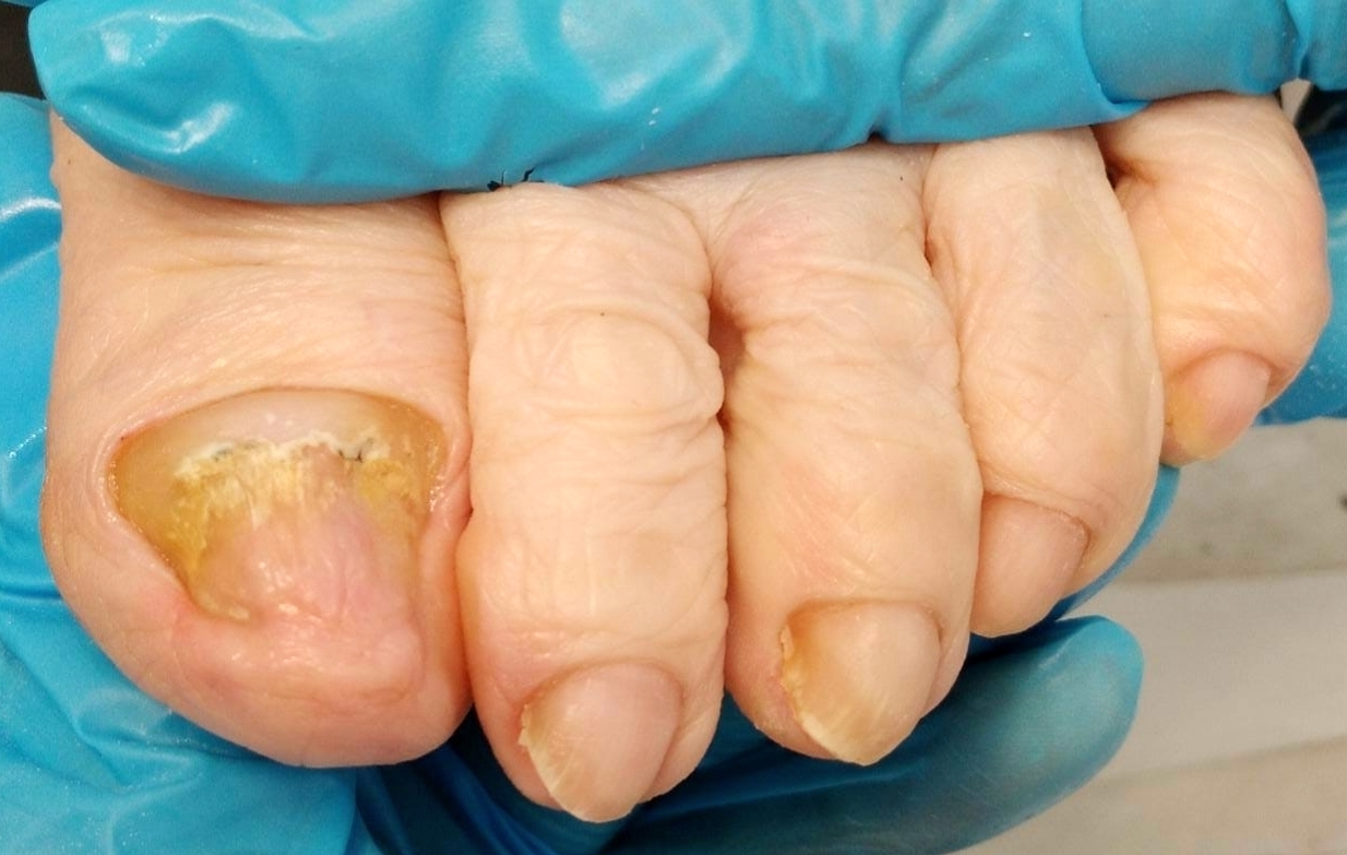 чистка ногтей от грибка и онихогрифоза