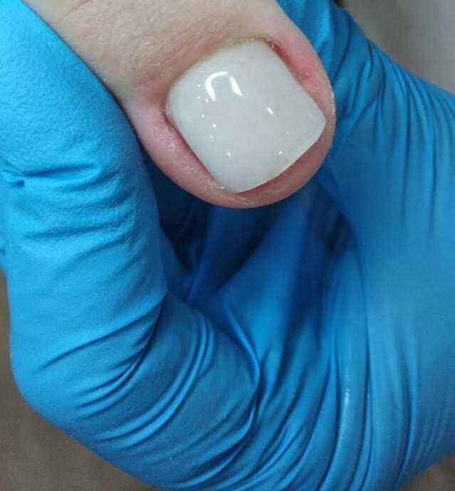 Протезирование ногтя, выполняется специальным противогрибковым гелем