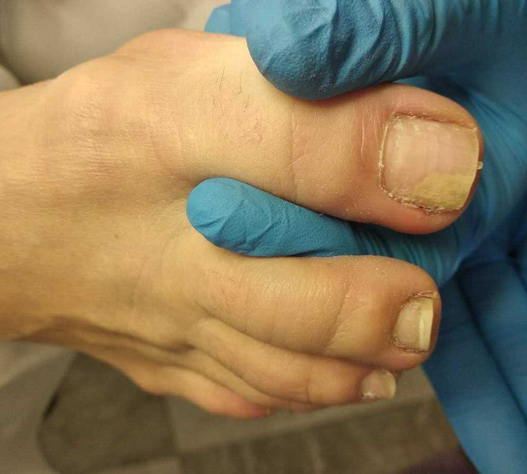 Онихолизис ногтей образование пустот под ногтями в следствии травмирования