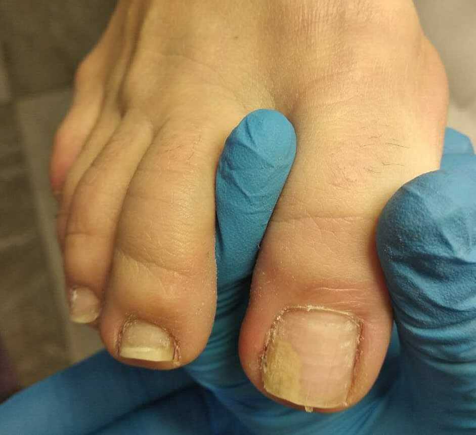 Онихолизис ногтей образование пустот под ногтями в следствии травмирования