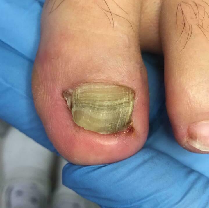 Деформация ногтя старая травма