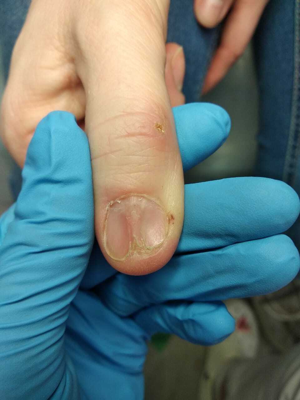 Онихорексис: причины и лечение расщепления ногтей